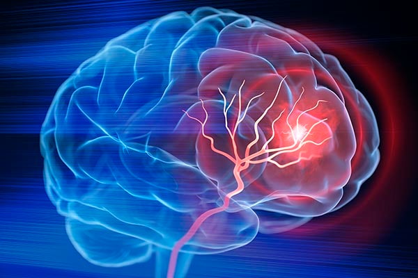 Stroke brain